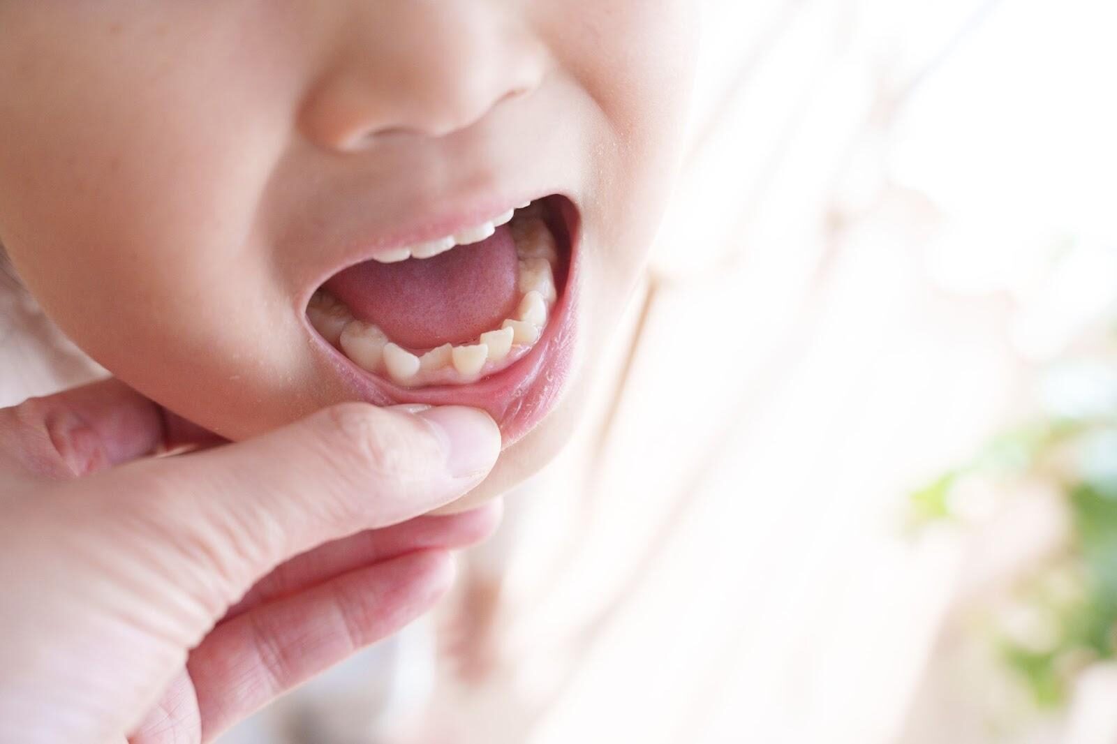 子ども向けマウスピース矯正の種類